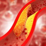 Cholesterol : शरीर में दिखाई देने लगे यह लक्षण, तो बरते सावधानी, हार्ट अटेक का भी हो सकते है शिकार