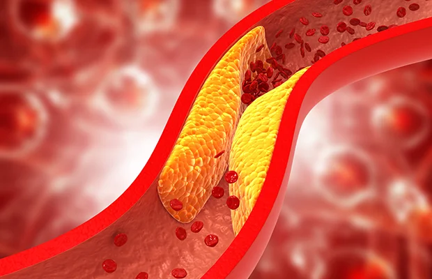 Cholesterol : शरीर में दिखाई देने लगे यह लक्षण, तो बरते सावधानी, हार्ट अटेक का भी हो सकते है शिकार