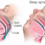 Sleep Apnea स्टडी के अनुसार स्लीप एपनिया का रिक्स कम करने के बारे में जाने, क्या तरीके मददगार हो सकते है