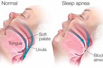 Sleep Apnea स्टडी के अनुसार स्लीप एपनिया का रिक्स कम करने के बारे में जाने, क्या तरीके मददगार हो सकते है