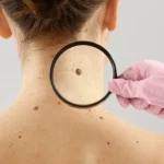 Skin Cancer की ओर इशारा करते हैं त्वचा में होने वाले ये बदलाव