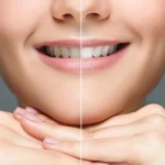 Teeth Whitening Tips इन नुस्खों से पाएं चमकदार दांत